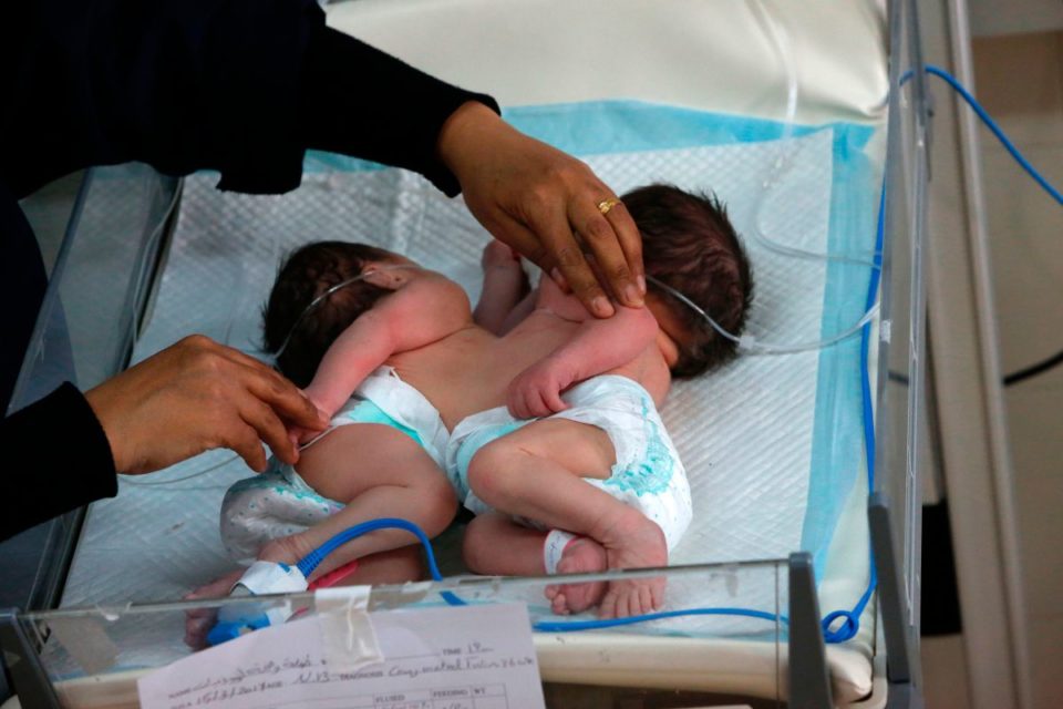 Dos siamesas en un hospital de Palestina.