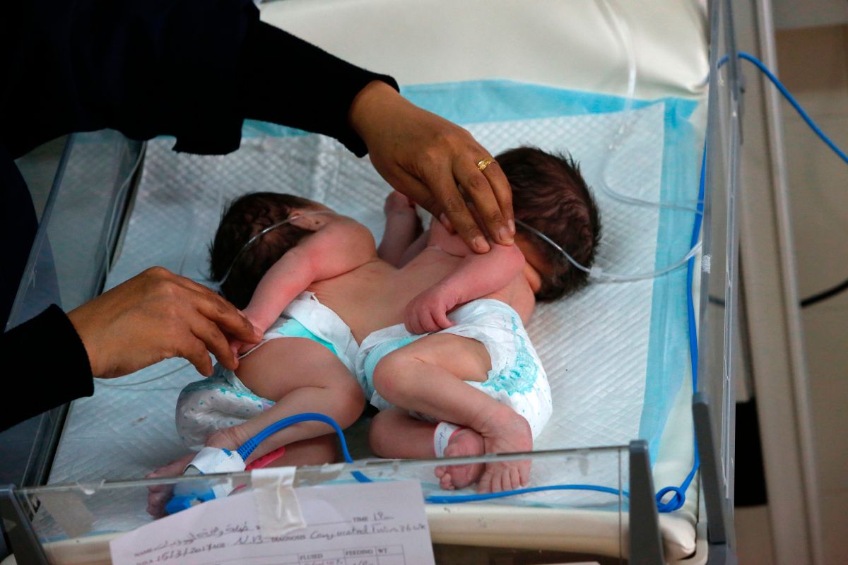 Dos siamesas en un hospital de Palestina.