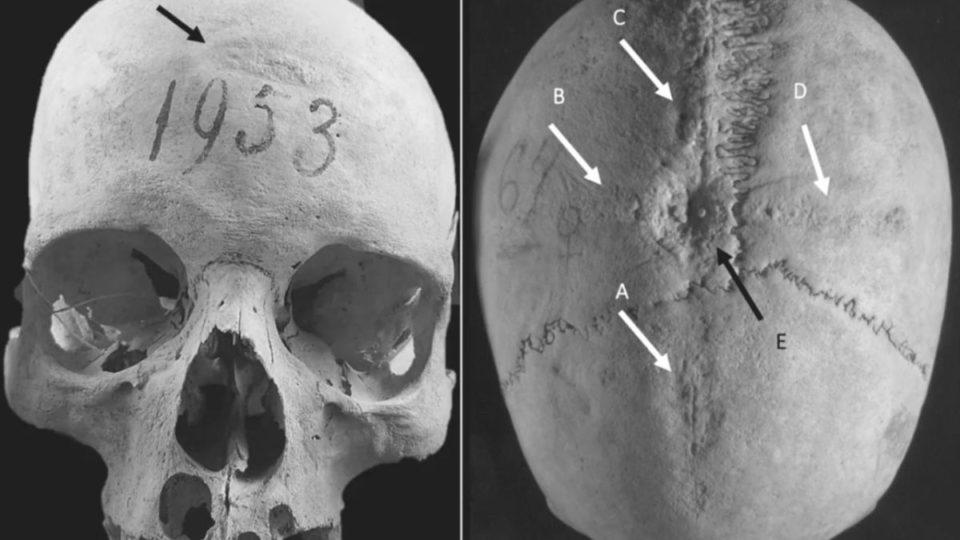 La trepanación pudo haber sido un procedimiento relativamente común en la antigüedad.